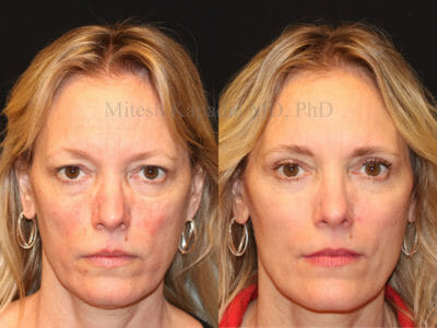 Woman in her mid-50s before and after upper eyelid surgery displaying a happier, less tired look