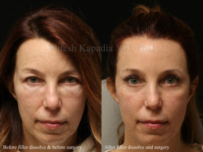Woman in her mid-50s before and after upper and lower blepharoplasty surgery with lower eyelid CO2 laser skin resurfacing. Her results leave her appearing more youthful, vibrant, and refreshed