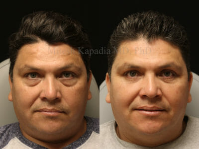 Man in his mid-40s before and after lower blepharoplasty surgery where one vial of filler was used during his post operative period. He shows a more youthful and well rested appearance without looking fake or overdone