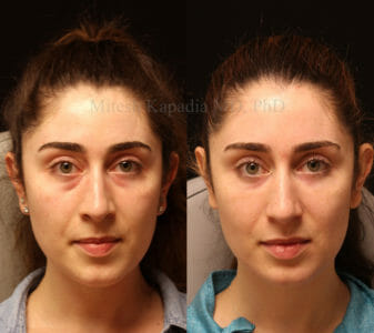 Woman in her mid-20s before and after lower eyelid surgery, showing a less tired and refreshed look