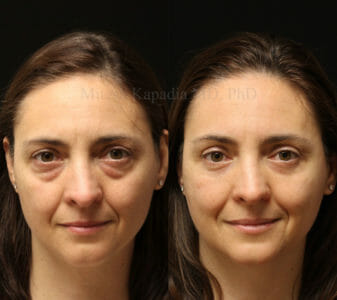 Woman in her mid-40s before and after lower eyelid surgery, revealing a vibrant, refreshed appearance