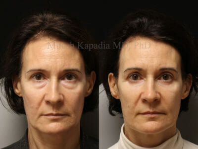 Woman in her early 50s before and after lower eyelid surgery, revealing a more youthful and rejuvenated appearance